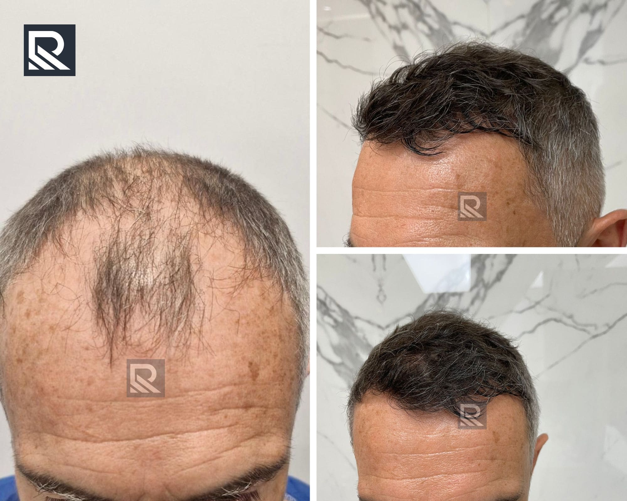 avant après greffe de cheveux FUE clinique Paris
