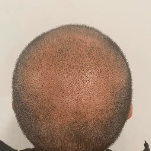 Après greffe de cheveux