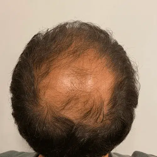 Avant greffe de cheveux